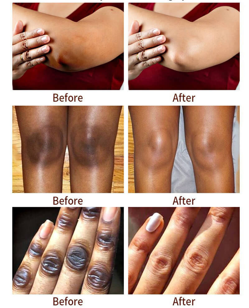 Dark knuckles serum whitening serum knuckle eraser elbow knee skin care