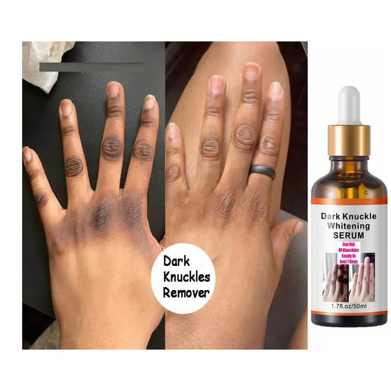 Dark knuckles serum whitening serum knuckle eraser elbow knee skin care