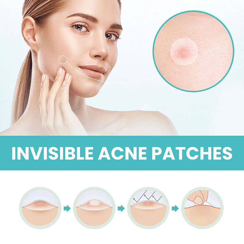180pcs acne patch invisible cleansing soothing acne cover with essential oil