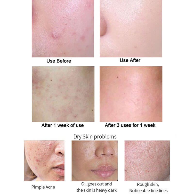 Face essence AHA fruit acid solution clean pore remove acne blackhead 30ml